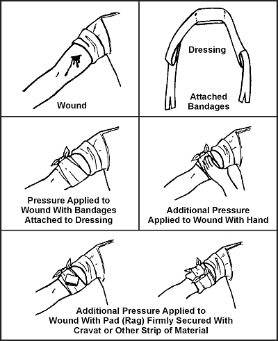 Figure 4-2. Application of a Pressure Dressing